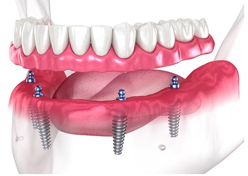All-on-4 Dental Implants