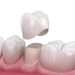 Dental crown that fell out