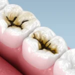Molar teeth damaged by caries 600nw — West Hollywood Smile Dental