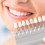 Choosing a veneer shade with a dentist