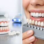 Veneers vs Teeth Whitening: Which Fits?