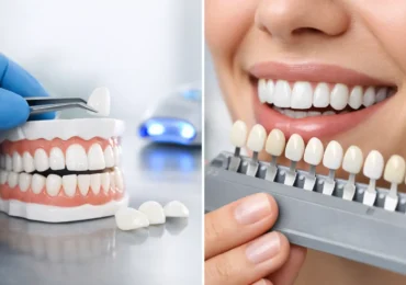 Veneers vs Teeth Whitening: Which Fits?