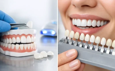 Veneers vs Teeth Whitening: Which Fits?