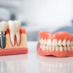 Dental Implants vs Dentures: Which Fits You?