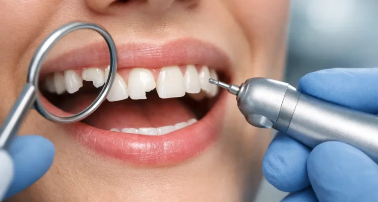 How to Fix Chipped Tooth Damage Fast