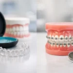 Invisalign vs Braces Cost: What to Expect