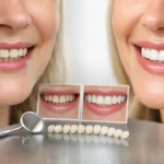 Smile Makeover Before After Examples Explained