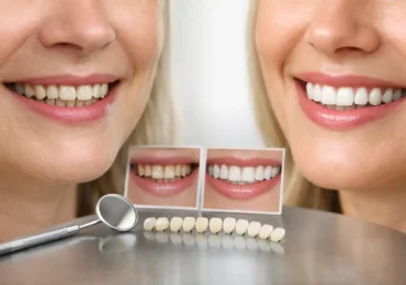 Smile Makeover Before After Examples Explained