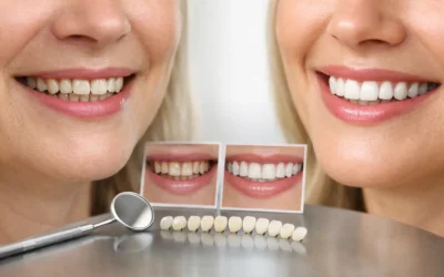 Smile Makeover Before After Examples Explained