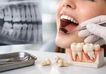 When Should Wisdom Teeth Come Out? Key Signs