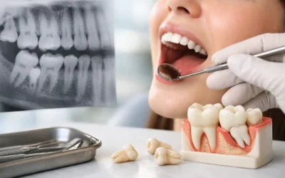 When Should Wisdom Teeth Come Out? Key Signs