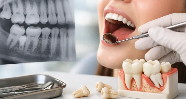 When Should Wisdom Teeth Come Out? Key Signs