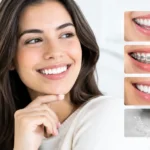 Best Options for Crooked Teeth That Fit Your Smile