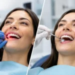 Laser Versus Traditional Gum Treatment Compared